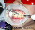 5.เป่าฟันและเหงือกในบริเวณที่จะสัมผัสกับน้ำยาฟอกสีฟันให้แห้งสนิท.