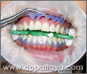 21.แกะเรซิ่นที่ใช้ป้องกันเหงือกไม่ให้สัมผัสกับน้ำยาฟอกสีฟันออก.