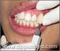 24.การฟอกสีฟันด้วย Cool Light Teeth Whitening เสร็จสิ้นกระบวนการภายใน 30 นาที
