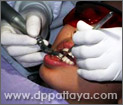 2.ทันตแพทย์จะทำการขัดบริเวณผิวฟัน เพื่อให้น้ำยาฟอกสีฟันสัมผัสกับผิวฟันได้มากที่สุด.