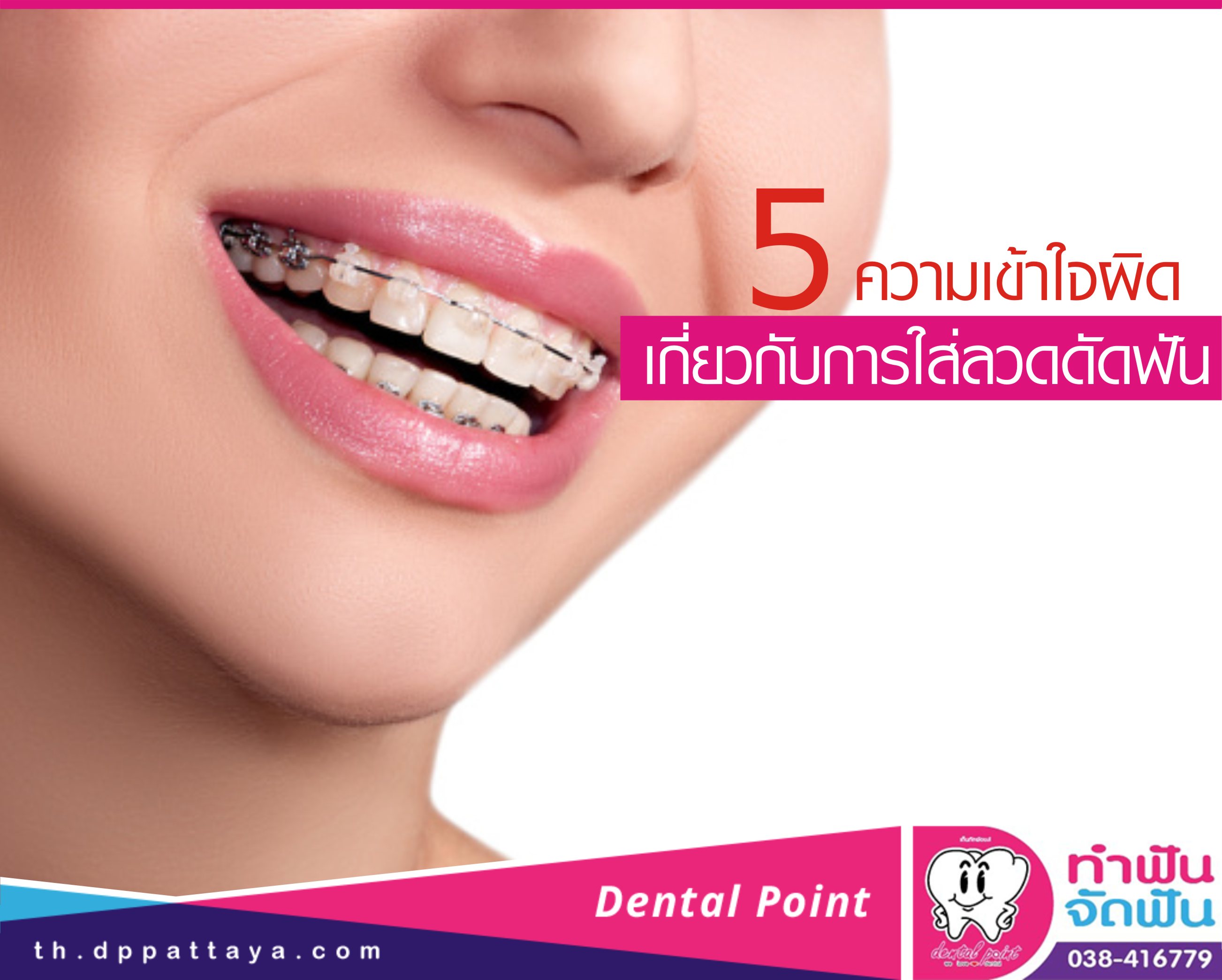 5 ความเข้าใจผิดเกี่ยวกับการใส่ลวดดัดฟัน