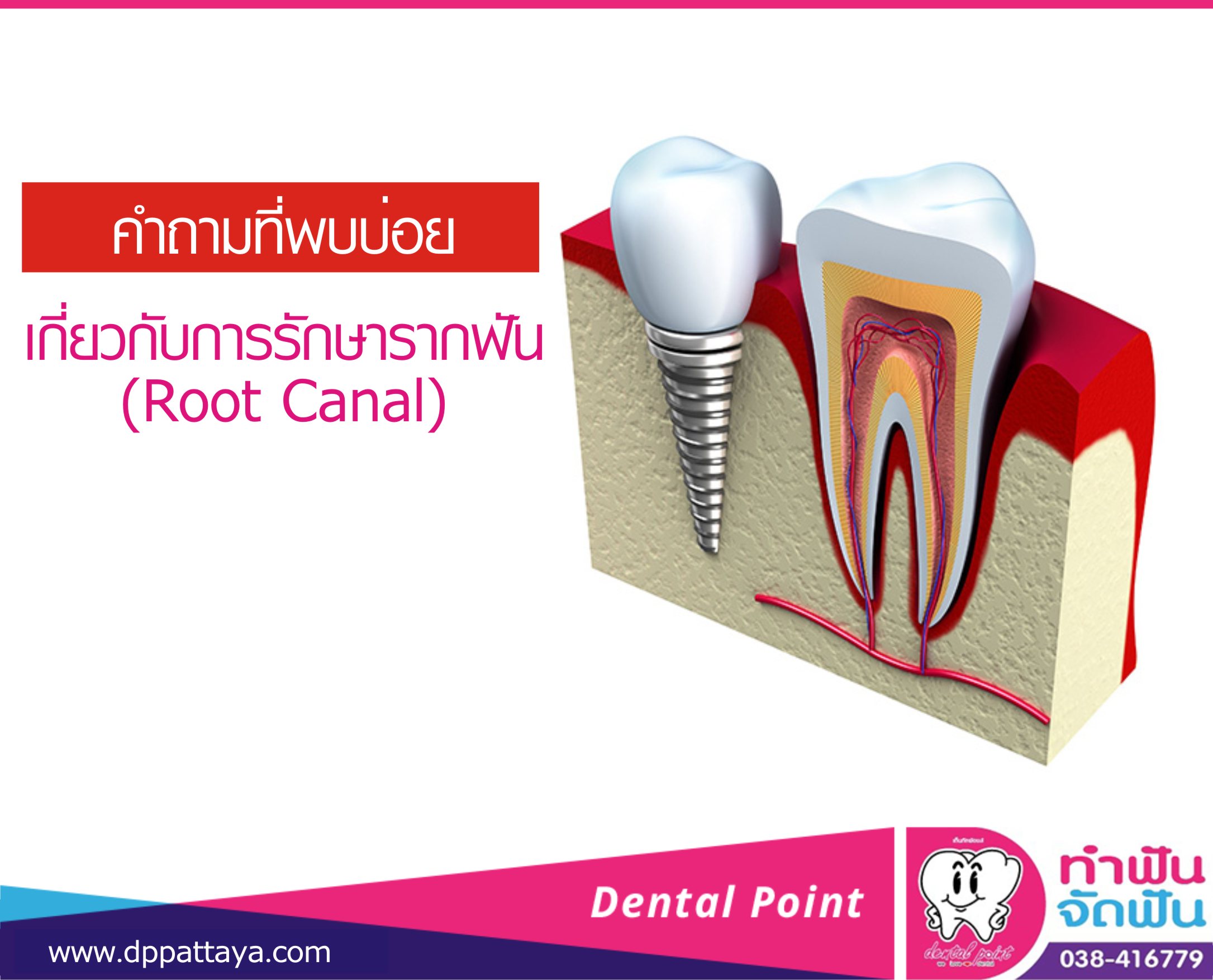 คำถามที่พบบ่อยเกี่ยวกับการรักษารากฟัน(Root Canal)