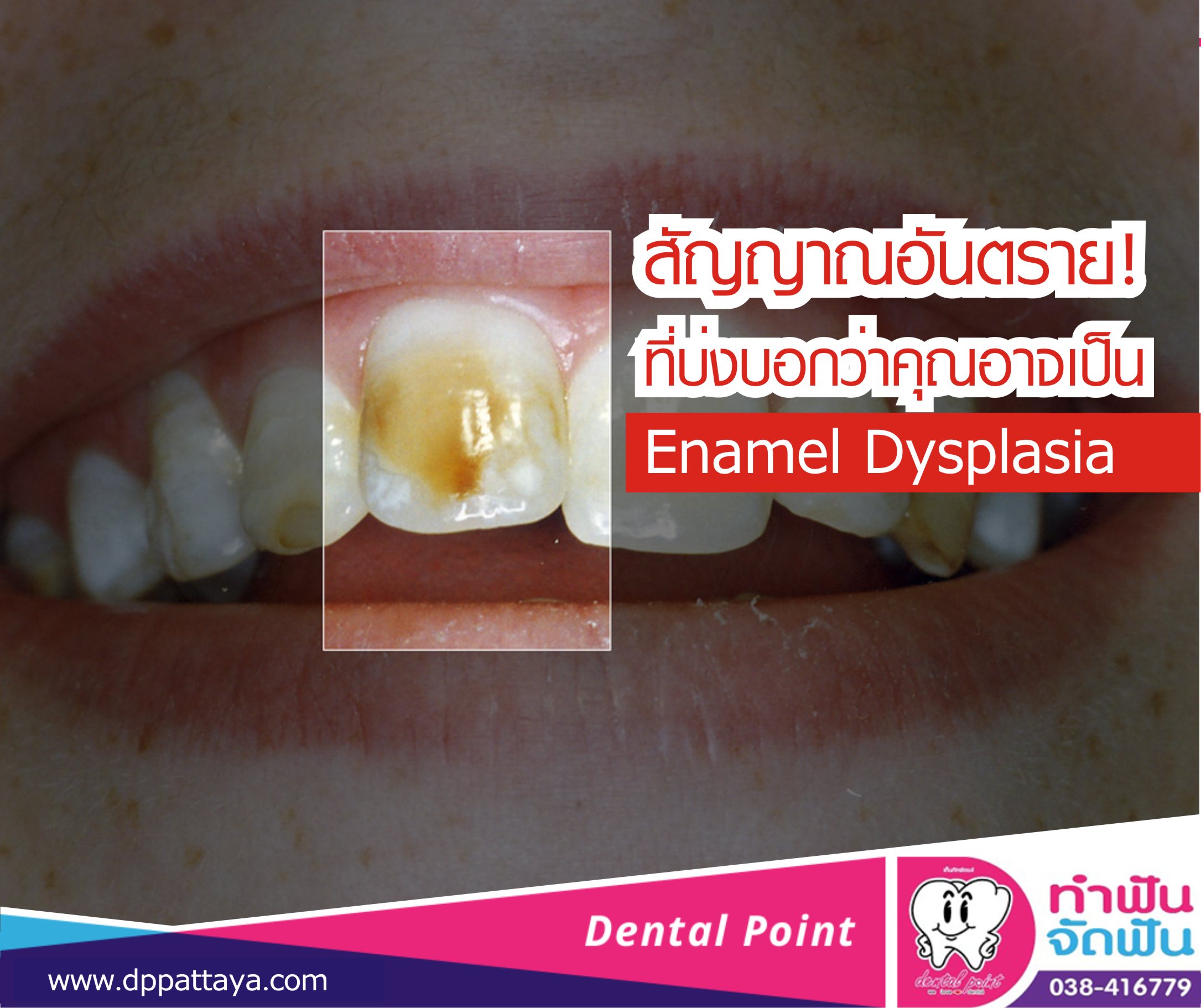 สัญญาณอันตราย! ที่บ่งบอกว่าคุณอาจเป็น Enamel Dysplasia