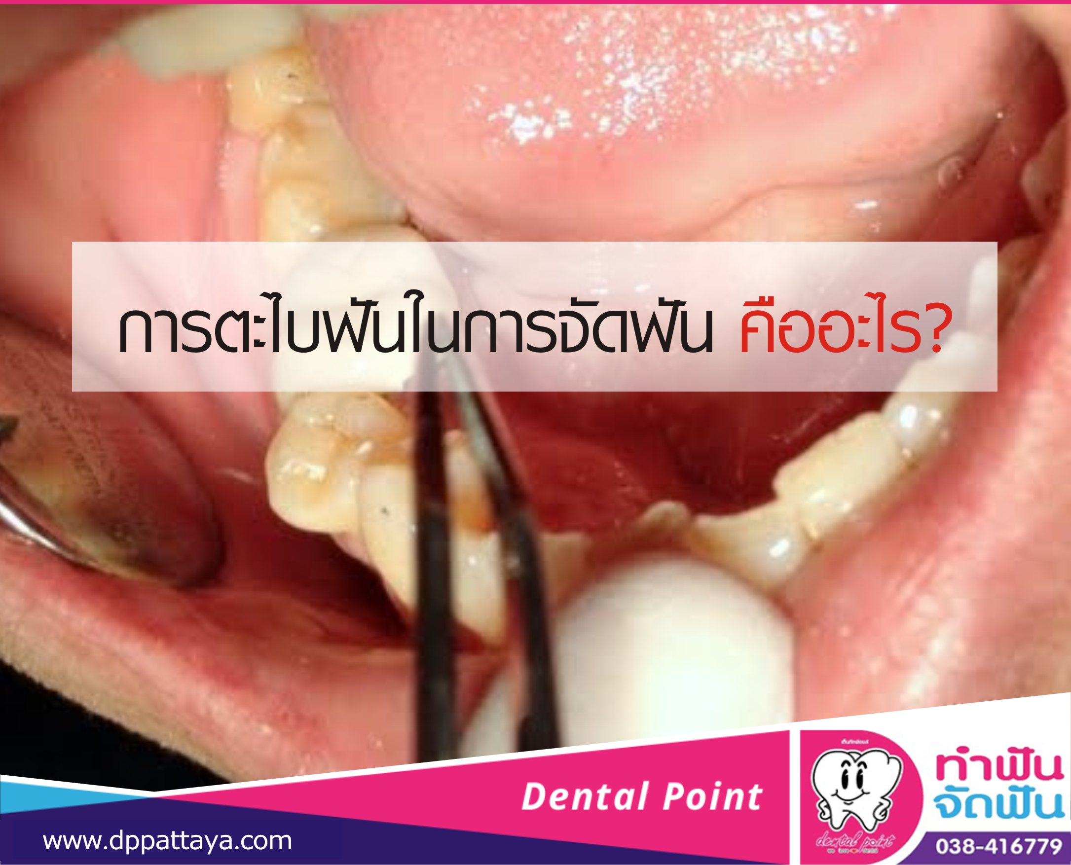 การตะไบฟันในการจัดฟัน คืออะไร? - คลินิกทำฟันพัทยา Dental Point