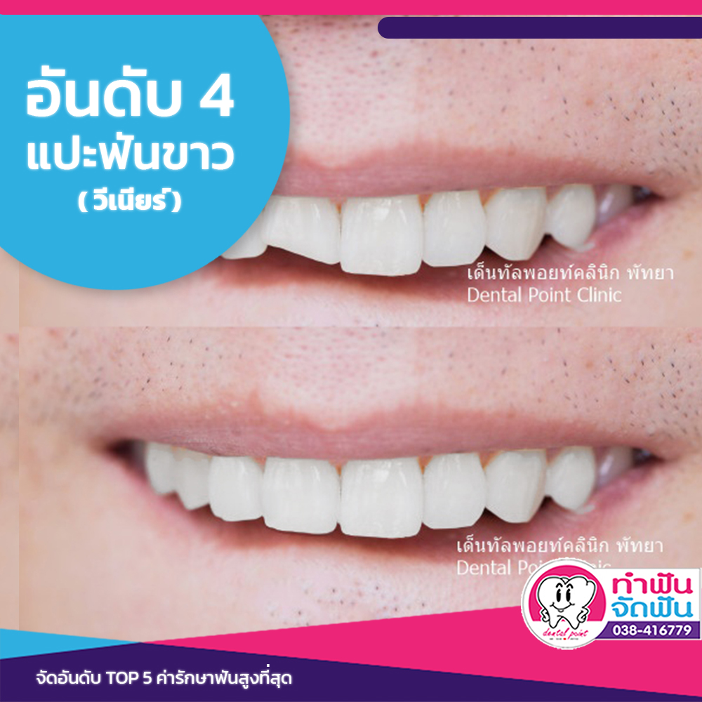 ค่ารักษาฟันอันดับ 4 แปะฟันขาว วีเนียร์