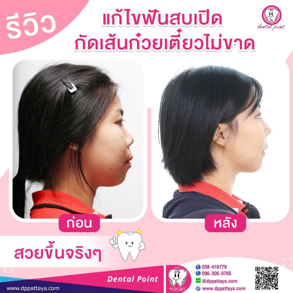 รีวิวจัดฟัน ฟันสบเปิด