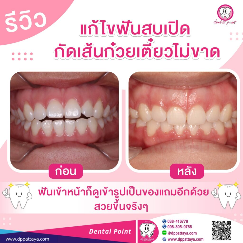 รีวิวจัดฟัน ฟันสบเปิด