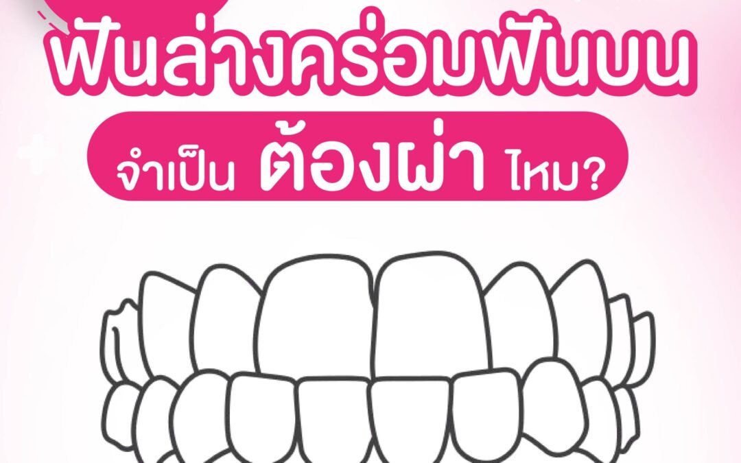 ฟันล่างคร่อมฟันบน อยากจัดฟัน จำเป็นต้องผ่าตัดไหม? รู้คำตอบที่นี่